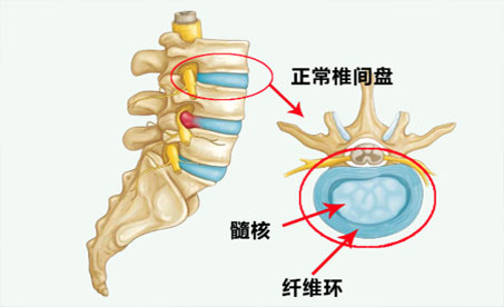 腰酸、痛、胀、麻、僵？很可能是这个病